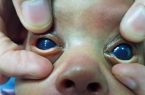 عملية جراحية ناجحة لإزالة مياه زرقاء من عين طفل عمره شهر ببيشة