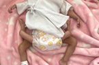 إجراء عملية فصل التوأم الطفيلي اليمني عائشة غدًا