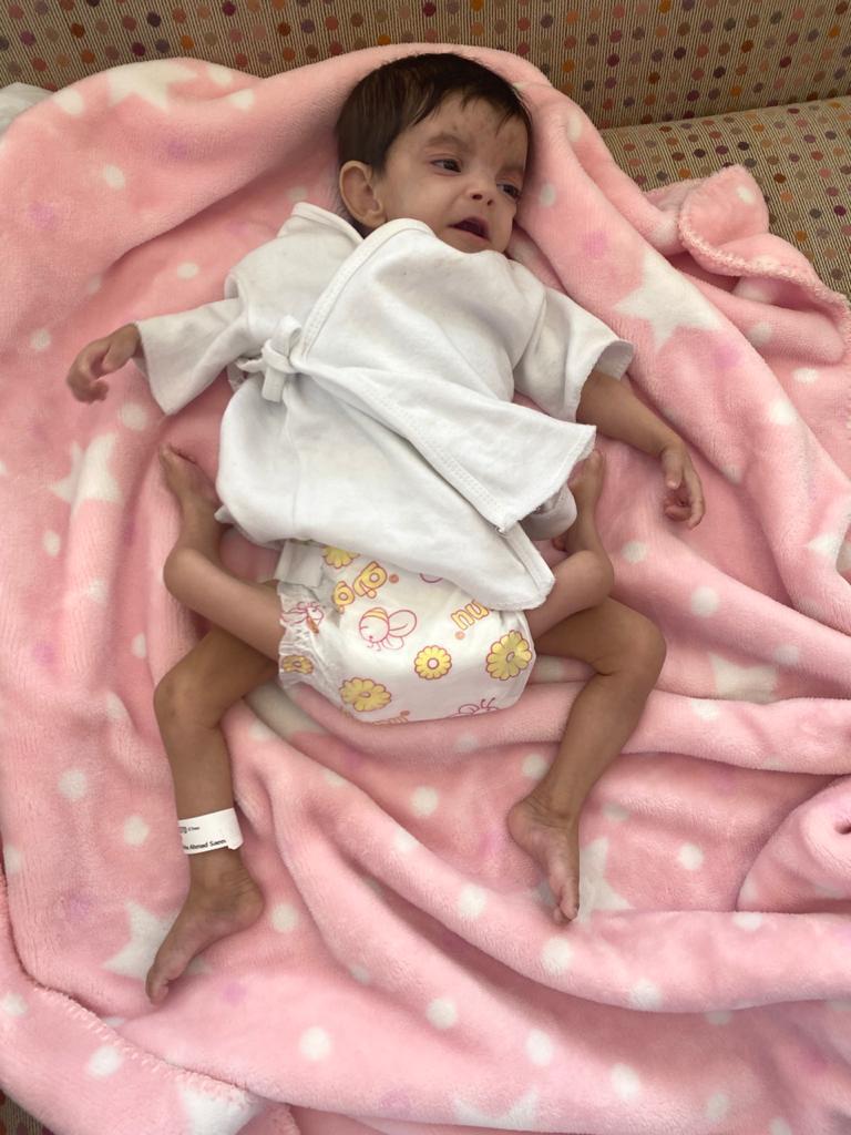 إجراء عملية فصل التوأم الطفيلي اليمني عائشة غدًا