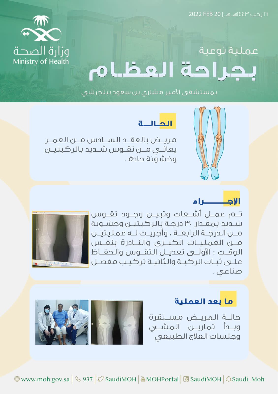 عملية نوعية بجراحة العظام بمستشفى الأمير مشاري بن سعود ببلجرشي